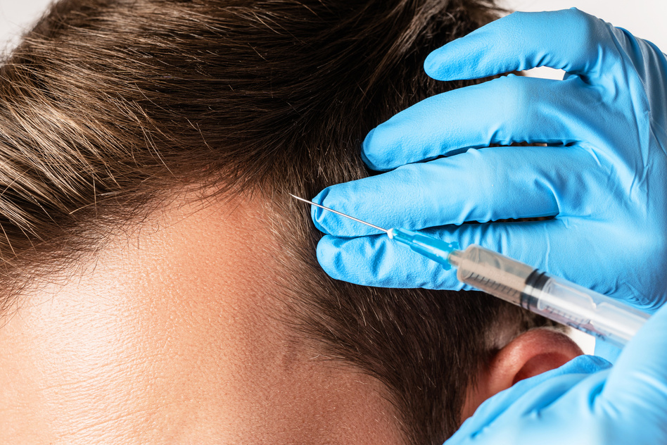 Man Receiving Scalp Injection for Hair Grow